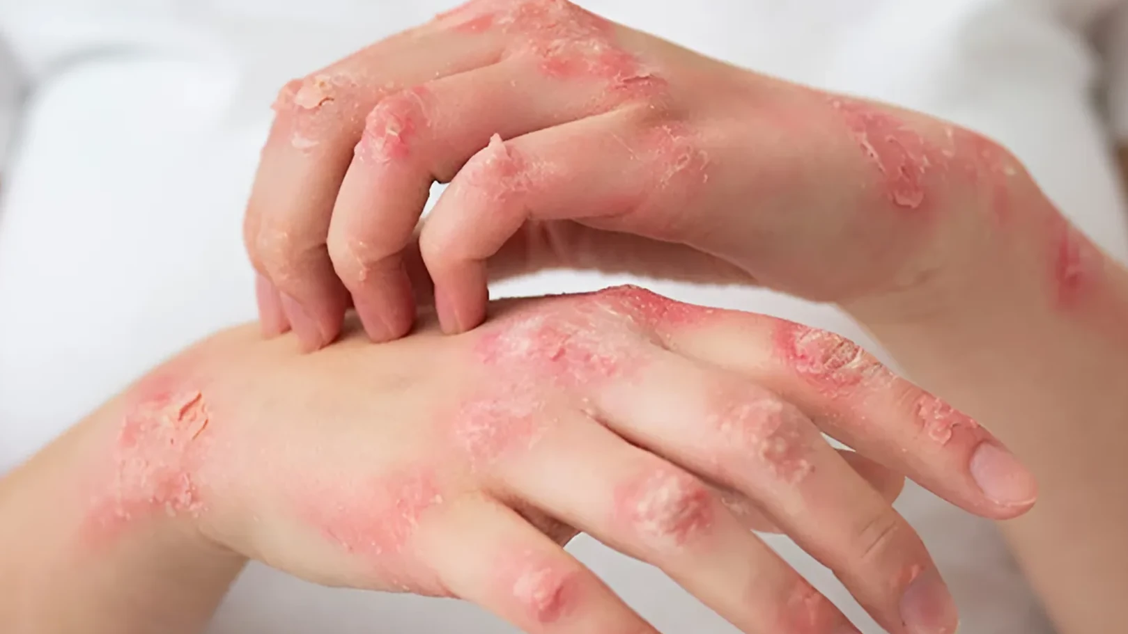 EXCIMER E-VN, CHÌA KHÓA ĐẨY LÙI NỖI LO VIÊM DA CƠ ĐỊA