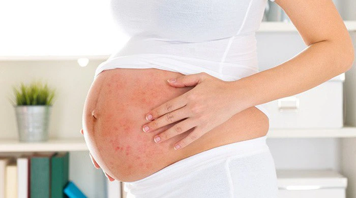 ĐIỀU TRỊ VẨY NẾN CHO MẸ BẦU