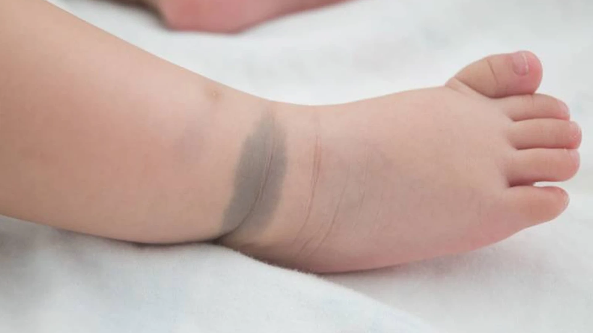 NHỮNG ĐIỀU MẸ BẦU NÊN TRÁNH KHI MANG THAI ĐỂ HẠN CHẾ CHÀM BỚT BẨM SINH Ở TRẺ SƠ SINH