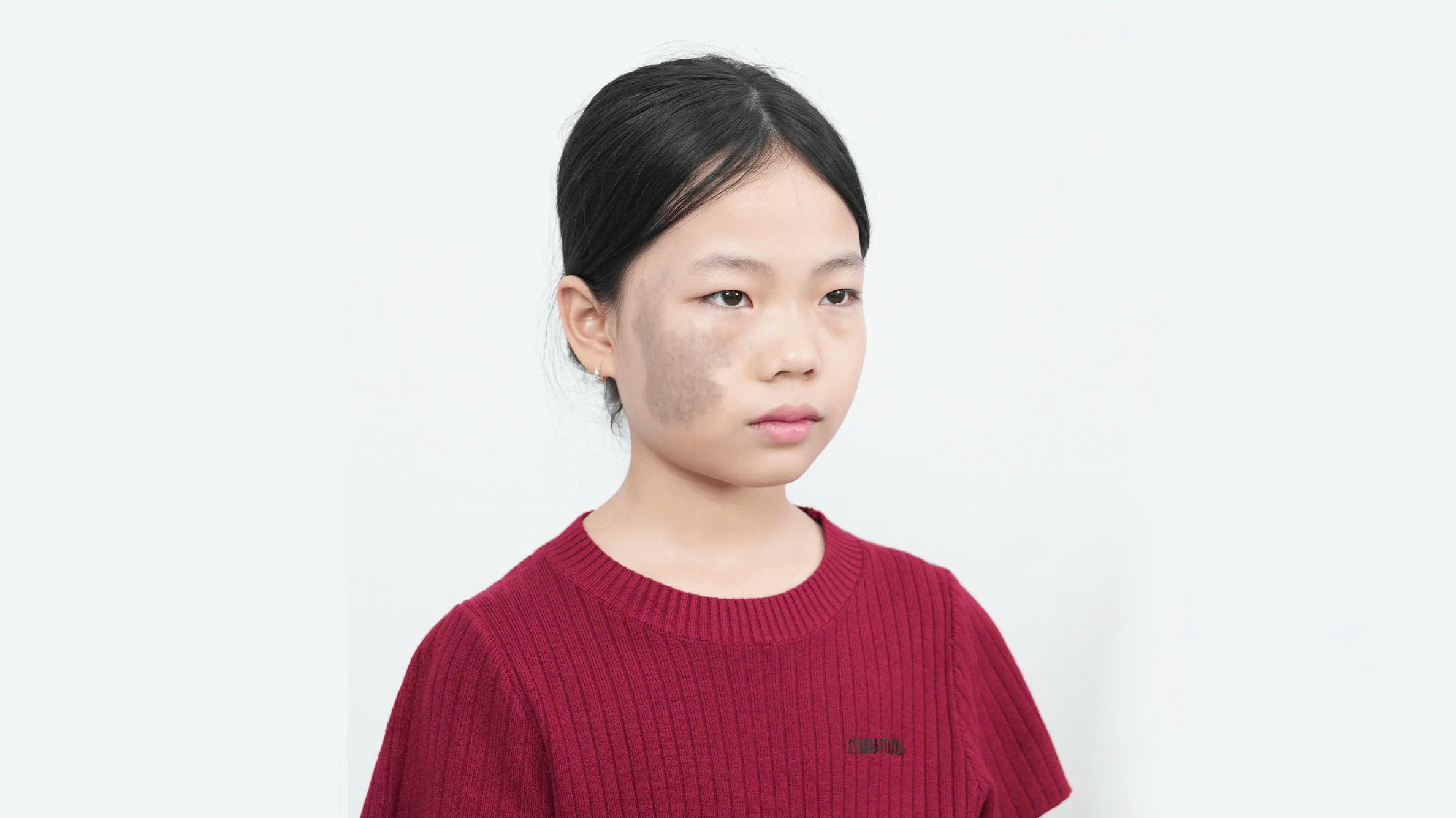 NHỮNG ĐIỀU MẸ BẦU NÊN TRÁNH KHI MANG THAI ĐỂ HẠN CHẾ CHÀM BỚT BẨM SINH Ở TRẺ SƠ SINH