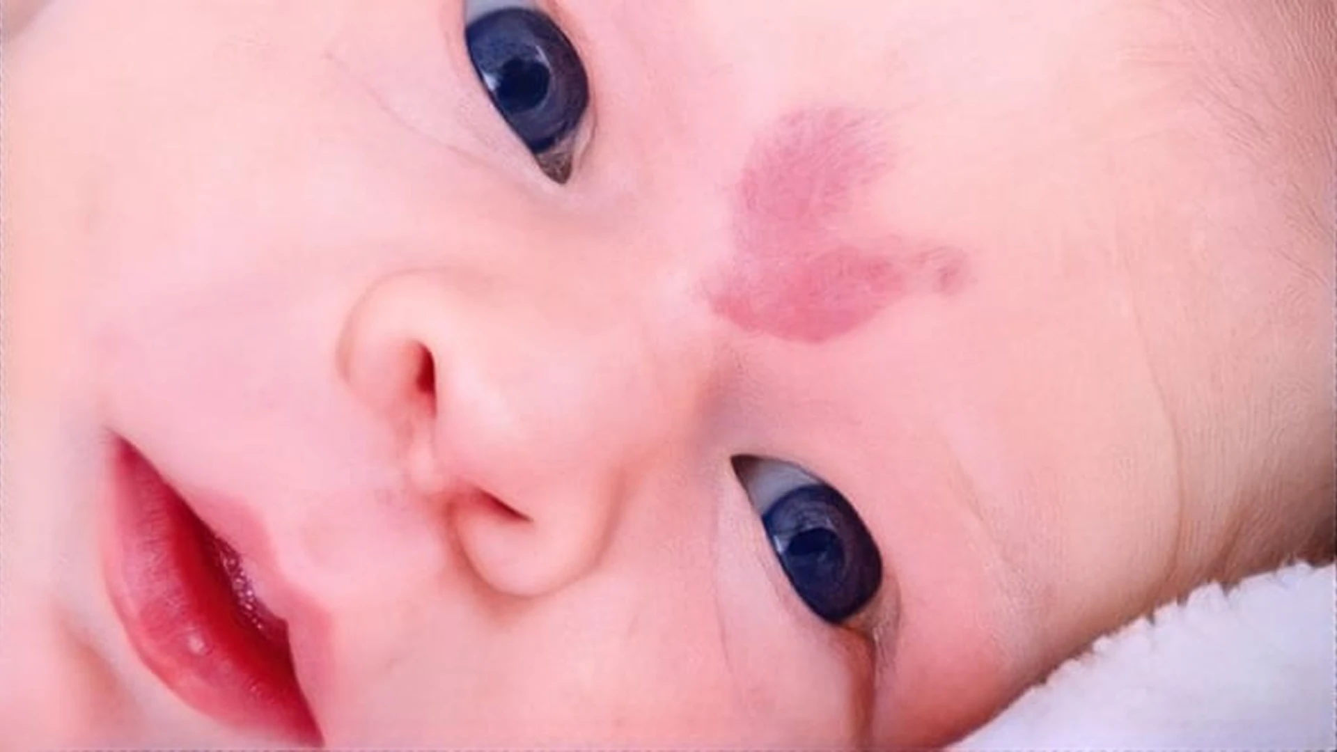 NHỮNG ĐIỀU MẸ BẦU NÊN TRÁNH KHI MANG THAI ĐỂ HẠN CHẾ CHÀM BỚT BẨM SINH Ở TRẺ SƠ SINH