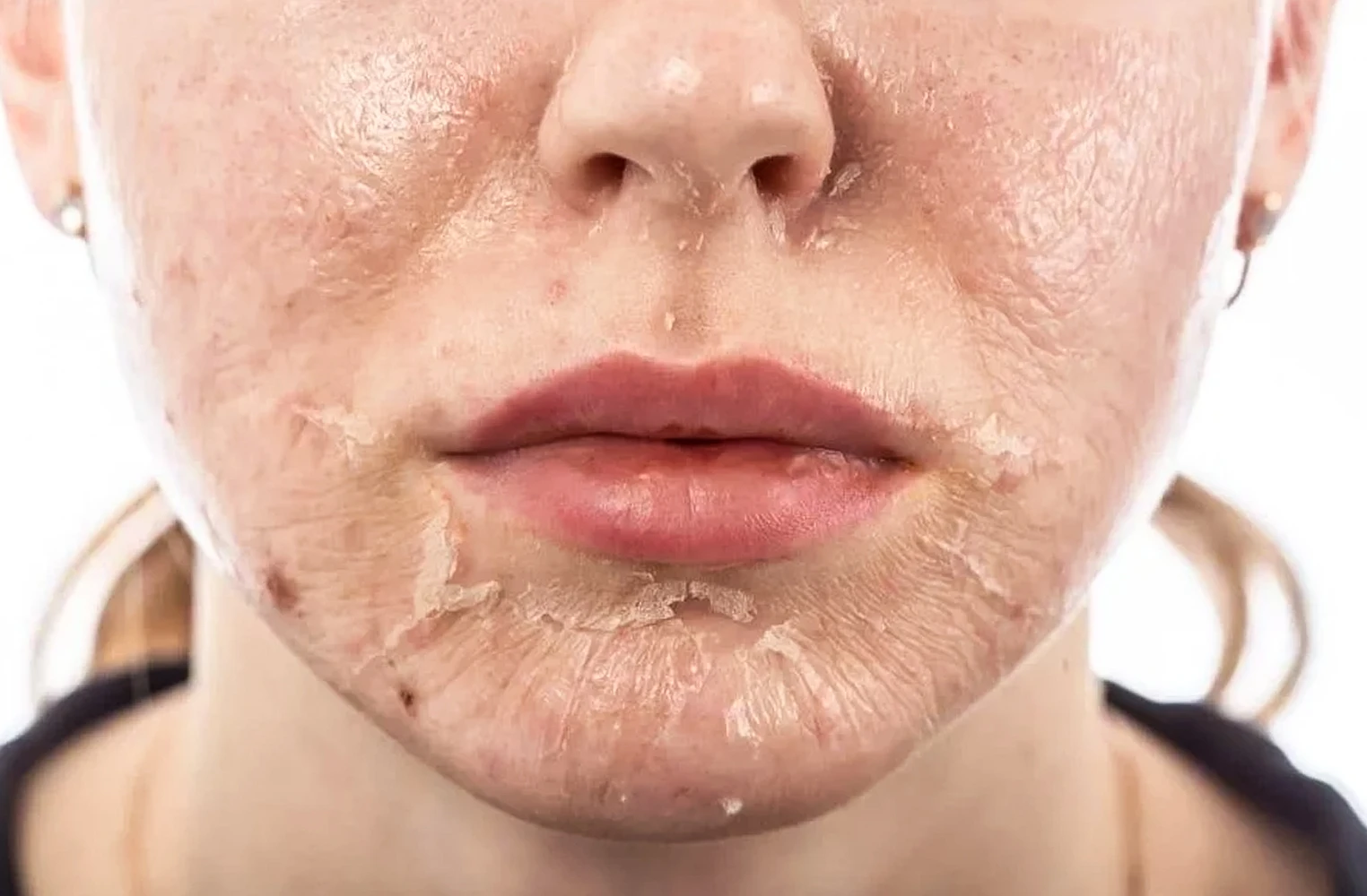 Lợi ích và rủi ro của phương pháp peel da – Chia sẻ từ PGS. TS Phạm Công Chính