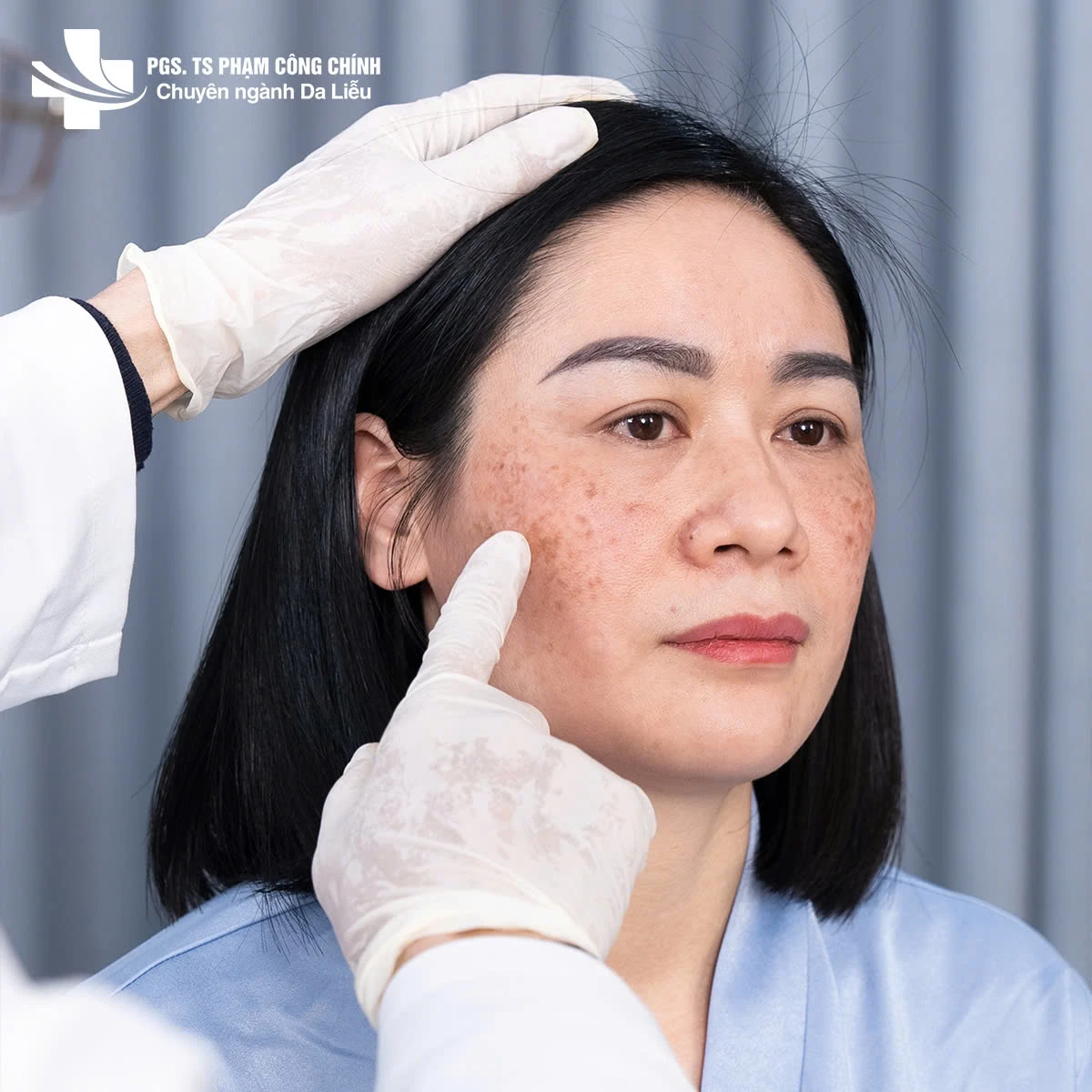 Hiểu đúng về nám da: Lời khuyên từ PGS.TS Phạm Công Chính