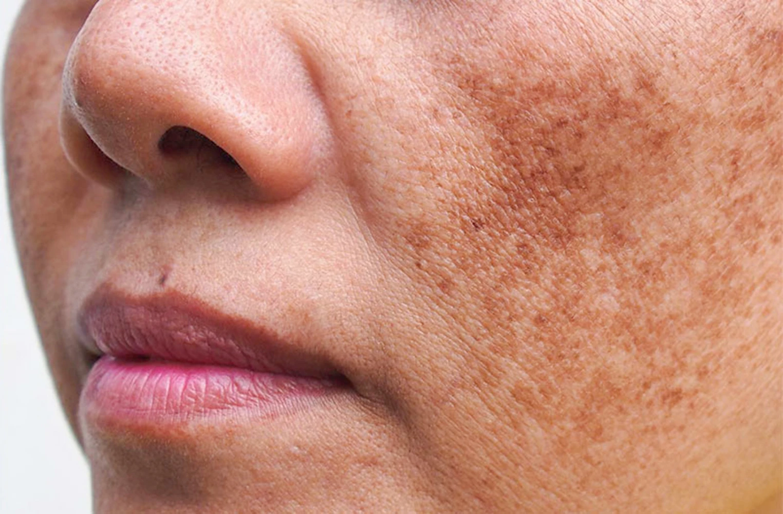 Lợi ích và rủi ro của phương pháp peel da – Chia sẻ từ PGS. TS Phạm Công Chính