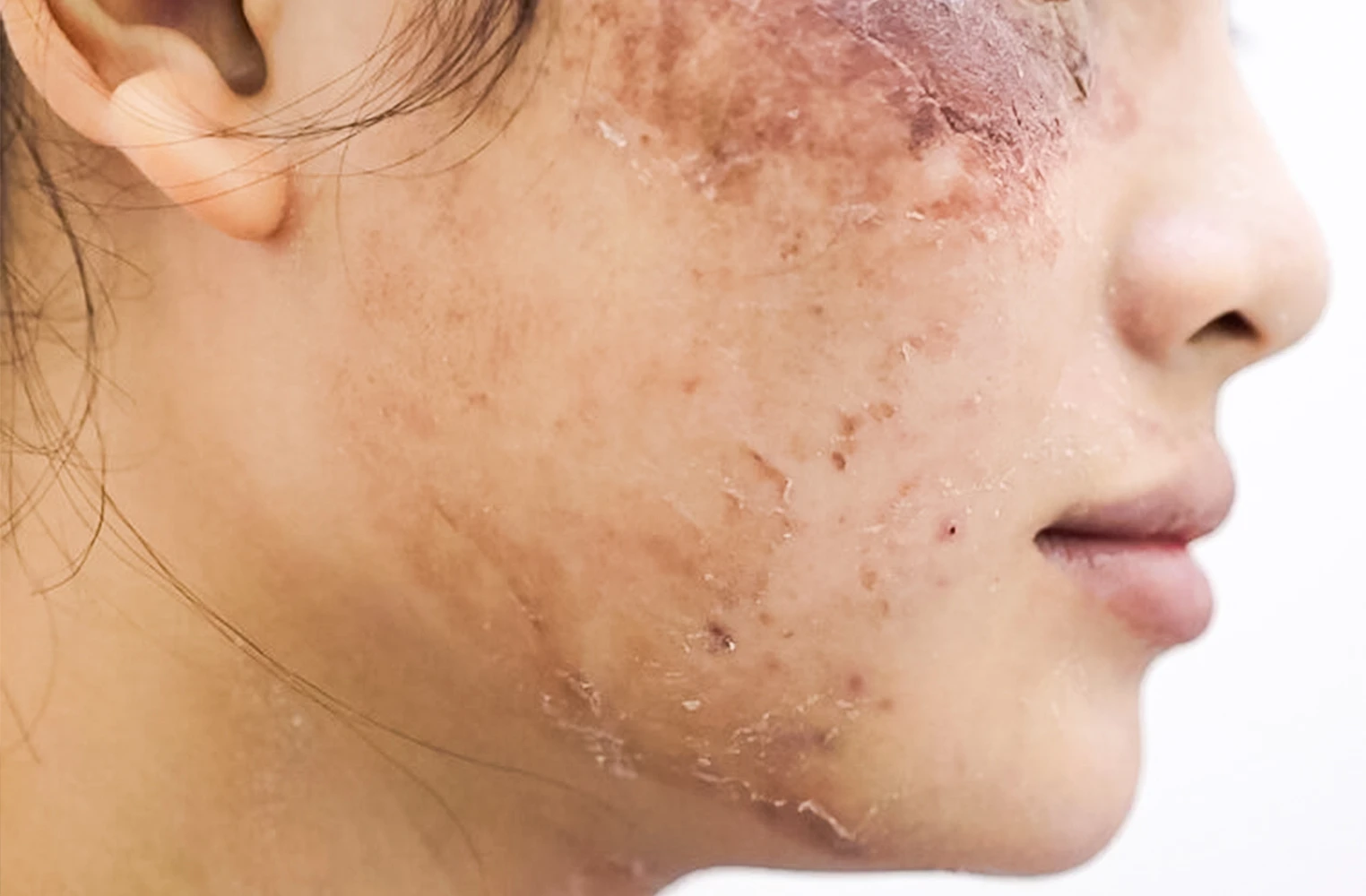 Lợi ích và rủi ro của phương pháp peel da – Chia sẻ từ PGS. TS Phạm Công Chính