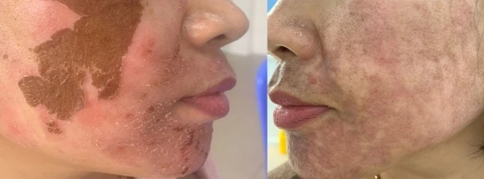 Điều trị nám khoa học dưới góc nhìn chuyên sâu từ PGS.TS.TTƯT Trần Lan Anh